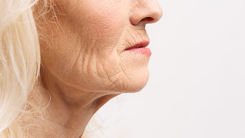 Treatments to reduce chin wrinkles