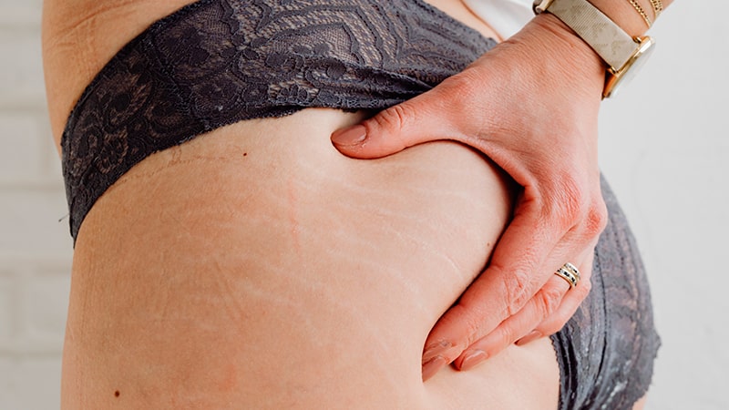 How to remove stretch marks